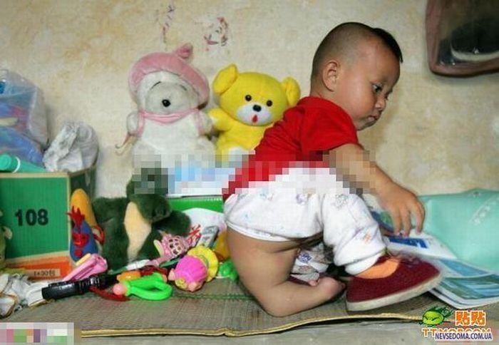 Chinese_doctors_remove_babys_third_arm_4.jpg