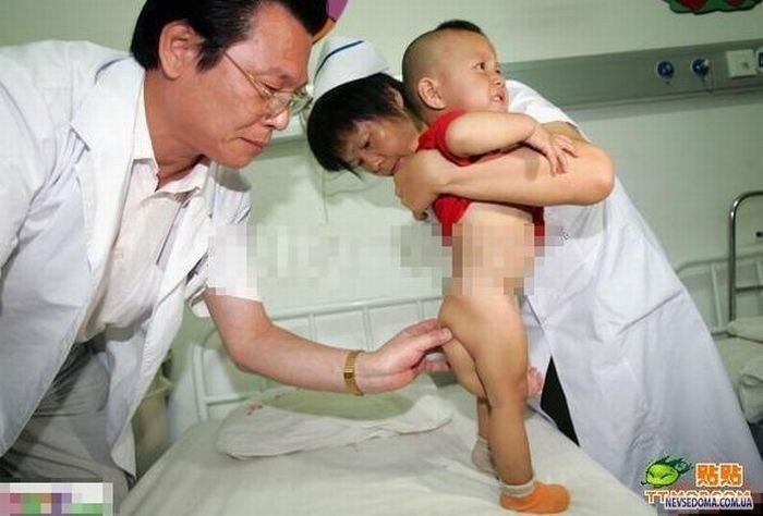 Chinese_doctors_remove_babys_third_arm_5.jpg