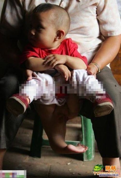 Chinese_doctors_remove_babys_third_arm_6.jpg